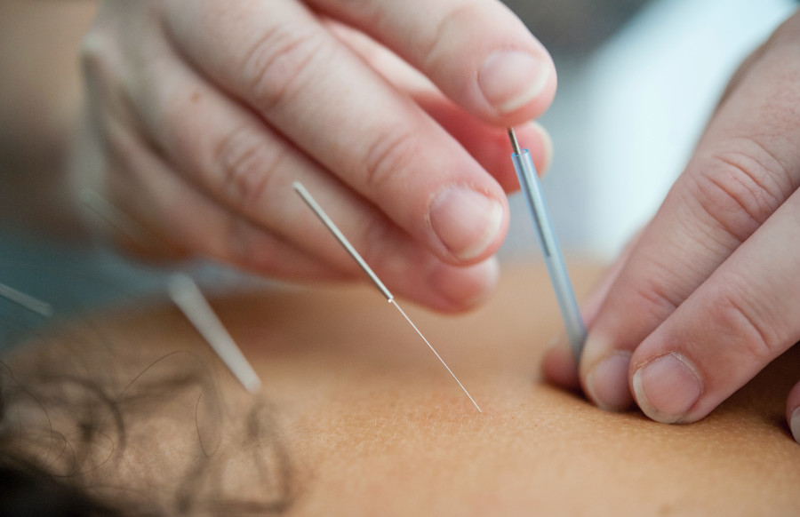 patient getting acupuncture needles in her back