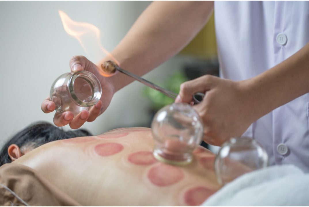 patient getting cupping therapy from a tcm doctor